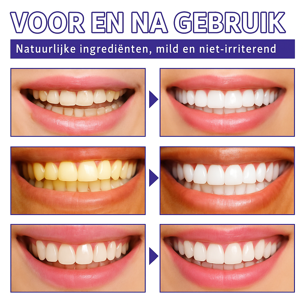 White Smile™| Stralend witte tanden