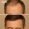 VEGAMOUR GRO| Krijg weer voller en sterker haar