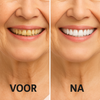 WitSmile Pro™| Stralend witte tanden zonder dure behandelingen