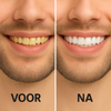 WitSmile Pro™| Stralend witte tanden zonder dure behandelingen