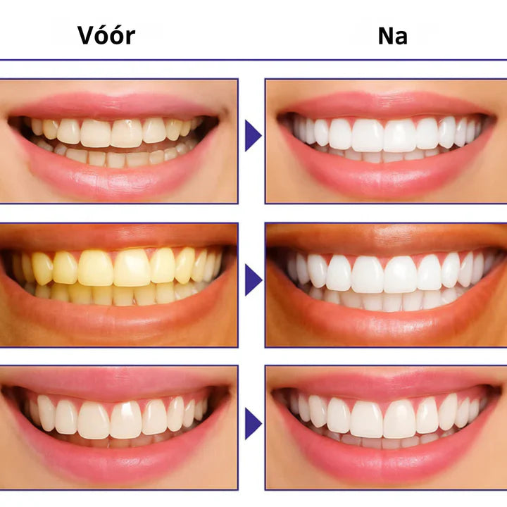 ThePerfectSmile™ | Verlicht je glimlach